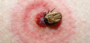 Borreliose-Zecken und die Folgen ihrer Stiche