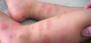 Wanzenstiche und ihre Behandlung