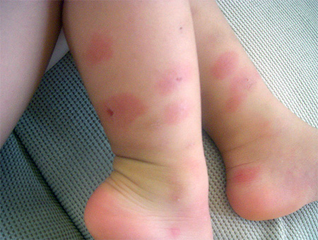 Beispiel einer leichten allergischen Reaktion auf Bettwanzenbisse Allergie auf einen Bettwanzenbiss