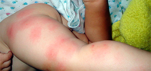 Beispiel einer Allergie gegen Flohstiche Beispiel einer Allergie gegen Flohstiche