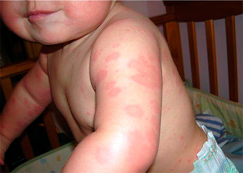 Beispiel einer Allergie bei einem Kind auf Bettwanzenbisse Beispiel einer Allergie bei einem Kind auf Bettwanzenbisse