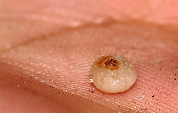 Und so sieht ein unter der Haut entfernter Sandfloh aus – er ist stark aufgebläht aufgrund der großen Anzahl von Eiern, die in ihm heranreifen. Und so sieht ein unter der Haut entfernter Sandfloh aus – er ist stark aufgebläht aufgrund der großen Anzahl von Eiern, die in ihm heranreifen.
