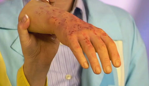 Anzeichen von Fleckfieber auf der Haut der Hand. Anzeichen von Fleckfieber auf der Haut der Hand