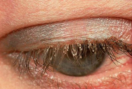Nissen an den Wimpern Nissen an den Wimpern