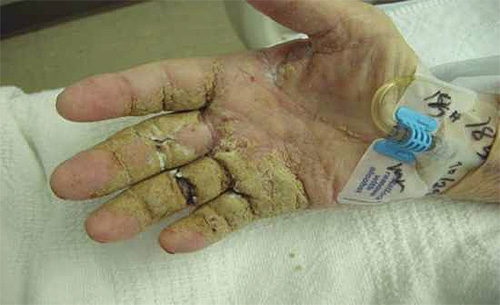 Hand einer Person mit Anzeichen einer norwegischen Krätze Hand einer Person mit Anzeichen einer norwegischen Krätze