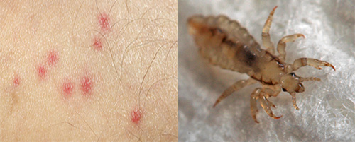 Bisse von Kleiderläusen unterscheiden sich deutlich von Bissen anderer Insekten. Wie man sie erkennt, erfahren wir weiter.