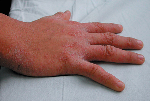 Auf dem Foto – Krätze-Erscheinungen auf der Haut der Hand Auf dem Foto – Krätze-Erscheinungen auf der Haut der Hand