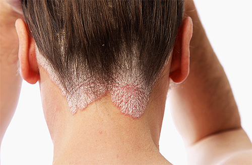 Die Symptome der Hautkrankheit Psoriasis können durchaus vor dem Hintergrund starker Belastungen auftreten Die Symptome der Hautkrankheit Psoriasis können durchaus vor dem Hintergrund starker Belastungen auftreten