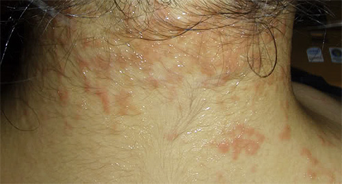 Wenn die Haut zu allergischen Ausschlägen neigt, sollte Full Marks mit Vorsicht angewendet werden. Wenn die Haut zu allergischen Ausschlägen neigt, sollte Full Marks mit Vorsicht angewendet werden.