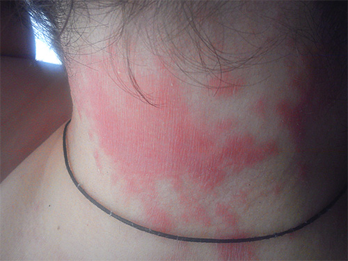 Bei Neigung zu Allergien kann die Anwendung von Nix zu Ausschlägen am Hals und auf der Kopfhaut führen. Bei Neigung zu Allergien kann die Anwendung von Nix zu Ausschlägen am Hals und auf der Kopfhaut führen.