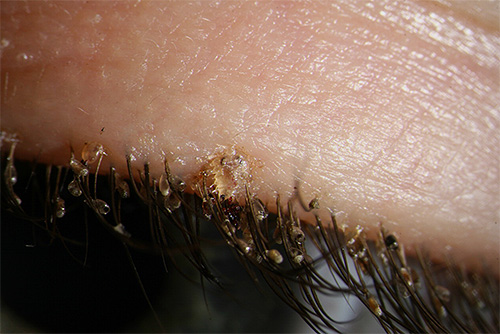 Filzläuse können auch auf den Wimpern des Menschen parasitieren Filzläuse können auch auf den Wimpern des Menschen parasitieren