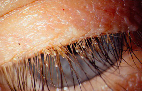 Nissen von Filzläusen auf den Wimpern sind gut sichtbar Nissen von Filzläusen auf den Wimpern sind gut sichtbar