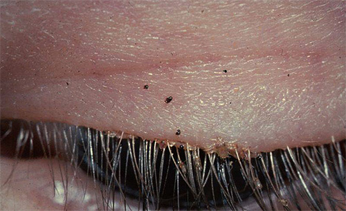 Ein weiteres Foto von Filzläusen und Nissen auf den Wimpern eines Menschen Ein weiteres Foto von Filzläusen und Nissen auf den Wimpern eines Menschen