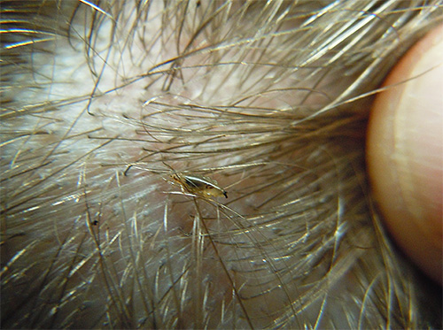 Kopflaus im Haar eines Kindes Kopflaus im Haar eines Kindes
