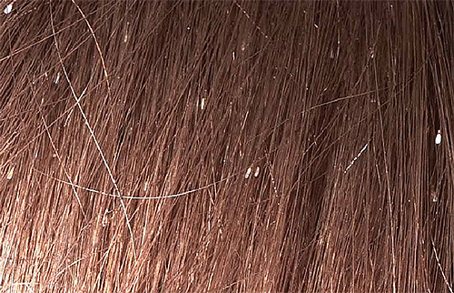 So sieht eine Vielzahl von Nissen auf den Haaren bei fortgeschrittener Pedikulose aus. So sieht eine Vielzahl von Nissen auf den Haaren bei fortgeschrittener Pedikulose aus.