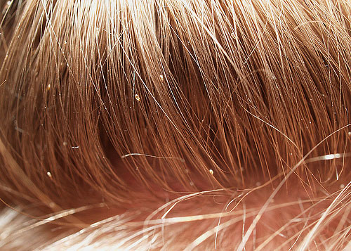 Selbst tote Nissen verleihen dem Haar ein sehr unansehnliches Aussehen Selbst tote Nissen verleihen dem Haar ein sehr unansehnliches Aussehen