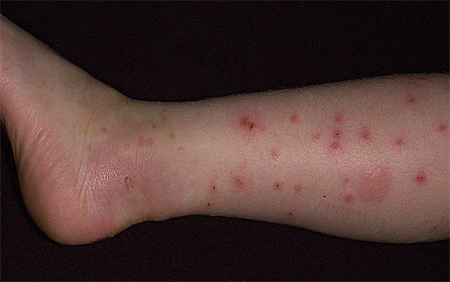 Bei mehrfachen und regelmäßig wiederkehrenden Flohbissen kann auch eine Behandlung gegen Würmer erforderlich sein. Bei mehrfachen und regelmäßig wiederkehrenden Flohbissen kann auch eine Behandlung gegen Würmer erforderlich sein.