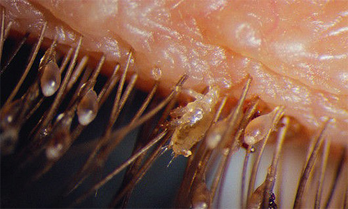 Schamläuse können auch an den Wimpern und Augenbrauen vorkommen Schamläuse können auch an den Wimpern und Augenbrauen vorkommen