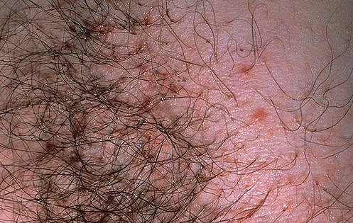 So sehen die Bisse von Schamläusen bei einem schwachen Parasitenbefall aus So sehen die Bisse von Schamläusen bei einem schwachen Parasitenbefall aus