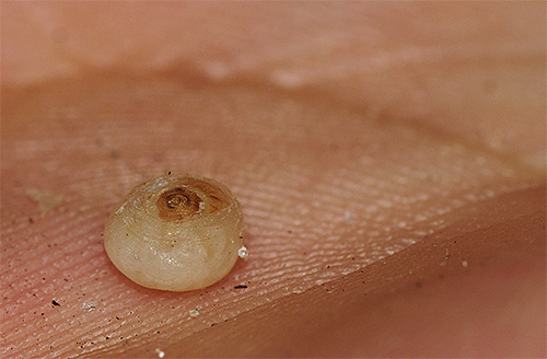 Auf dem Foto ist der durch die Eier aufgedunsene Körper des Sandflohs gut zu erkennen. Auf dem Foto ist der durch die Eier aufgedunsene Körper des Sandflohs gut zu erkennen.