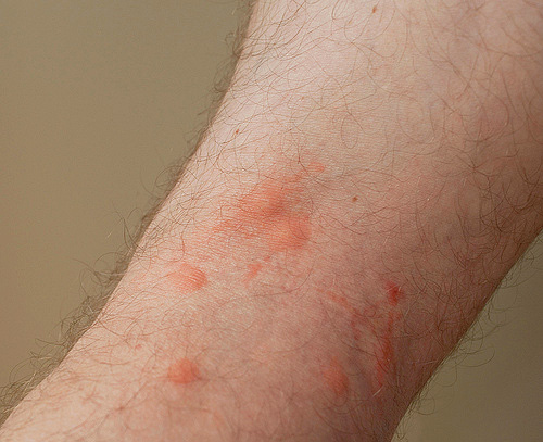 Flohbisse können nicht nur allergische Hautausschläge, sondern auch lokale Eiterungen zur Folge haben. Flohbisse können nicht nur allergische Hautausschläge, sondern auch lokale Eiterungen zur Folge haben.