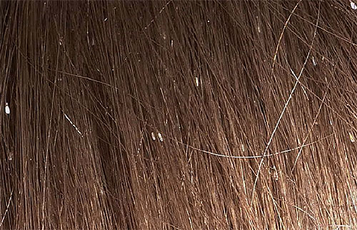 So sehen Nissen auf den Haaren aus So sehen Nissen auf den Haaren aus