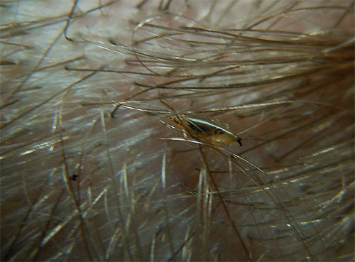 Die Kopflaus selbst sieht im Haar eines Kindes wie ein kleiner heller Käfer aus Die Kopflaus selbst sieht im Haar eines Kindes wie ein kleiner heller Käfer aus