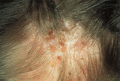 Bei starkem Läusebefall ähneln die Symptome denen, die bei Dermatitis auftreten Bei starkem Läusebefall ähneln die Symptome denen, die bei Dermatitis auftreten