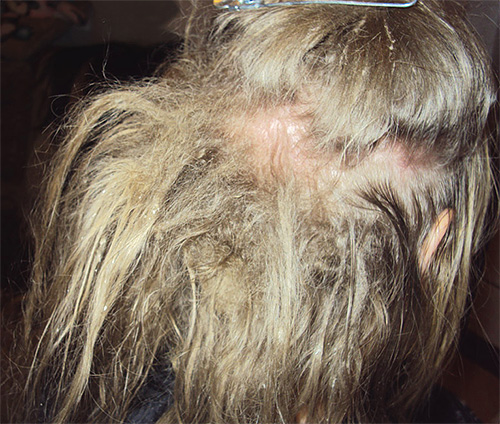 Ein weiteres Anzeichen für Läuse im Haar sind Verfilzungen. Ein weiteres Anzeichen für Läuse im Haar sind Verfilzungen.