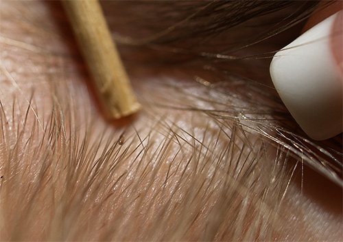 Wenn Sie die Haare mit den Fingern oder einer Pinzette spreizen, können Sie die Nissen und die Läuse selbst gut erkennen. Wenn Sie die Haare mit den Fingern oder einer Pinzette teilen, können Sie Nissen und die Läuse selbst gut erkennen.