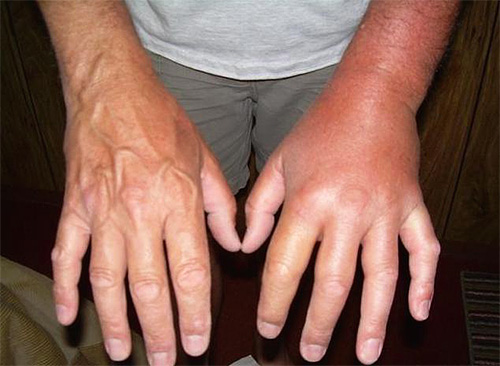 Auf dem Foto – eine Hand, die nach einem Hornissenstich angeschwollen ist. Auf dem Foto – eine Hand, die nach einem Hornissenstich angeschwollen ist.