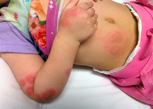 Wanzenbisse bei Kindern sind besonders gefährlich und können langfristige Folgen haben. Wanzenbisse bei Kindern sind besonders gefährlich und können langfristige Folgen haben.