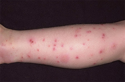Flohbisse können allergische Reaktionen und Dermatitis verursachen Flohbisse können allergische Reaktionen und Dermatitis verursachen