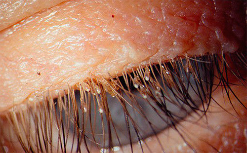 Filzläuse können die Wimpern und Augenbrauen eines Menschen befallen.