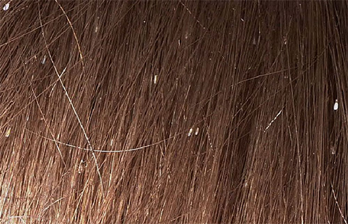 Nissen auf den Haaren sehen aus wie kleine weiße Punkte. Nissen auf den Haaren sehen aus wie kleine weiße Punkte.
