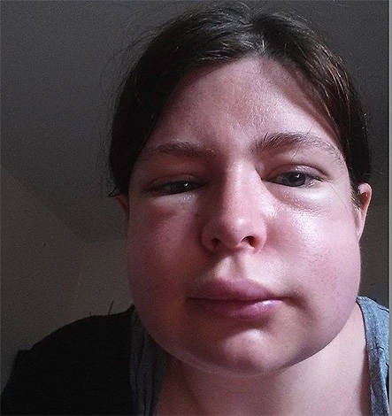 Folgen eines Hornissenstichs im Gesicht Folgen eines Hornissenstichs im Gesicht