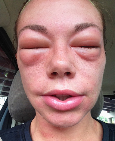 Wenn sich nach einem Hornissenstich schnell eine allgemeine allergische Reaktion des Körpers entwickelt, darf man mit der ersten Hilfe nicht zögern... Wenn sich nach einem Hornissenstich schnell eine allgemeine allergische Reaktion des Körpers entwickelt, darf man mit der ersten Hilfe nicht zögern...