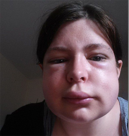 Wenn die Reaktion des Körpers auf einen Hornissenstich weiter zunimmt, muss die betroffene Person so schnell wie möglich ins Krankenhaus gebracht werden. Wenn die Reaktion des Körpers auf einen Hornissenstich weiter zunimmt, muss die betroffene Person so schnell wie möglich ins Krankenhaus gebracht werden