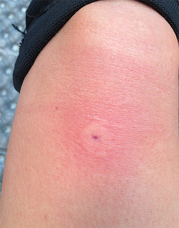 Wenn Sie in der Natur von einer Wespe gestochen wurden, können Sie eines der Hausmittel anwenden. Wenn Sie in der Natur von einer Wespe gestochen wurden, können Sie eines der Hausmittel anwenden.