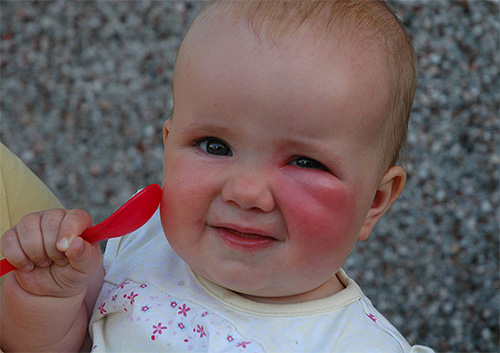 Zur Behandlung der Stichstelle bei einem kleinen Kind kann der Balsam Gardex Baby verwendet werden. Zur Behandlung der Stichstelle bei einem kleinen Kind kann der Balsam Gardex Baby verwendet werden.