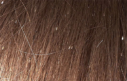 Nissen in den Haaren Nissen in den Haaren