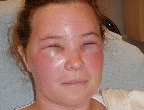 Die Gifte von Hautflüglern, einschließlich der Wespen, haben eine ausgeprägte allergene Wirkung. Die Gifte von Hautflüglern, einschließlich der Wespen, haben eine ausgeprägte allergene Wirkung.