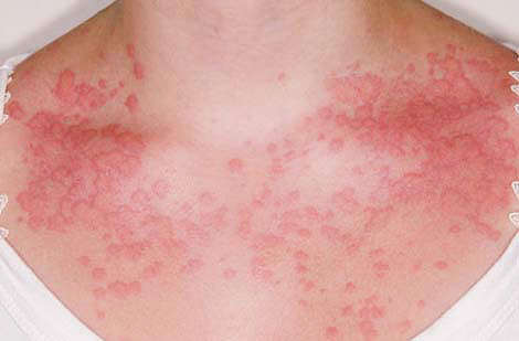 Auch eine starke allergische Reaktion in Form von Hautausschlag während der Schwangerschaft ist ein Grund, einen Arzt aufzusuchen. Auch eine starke allergische Reaktion in Form von Hautausschlag während der Schwangerschaft ist ein Grund, einen Arzt aufzusuchen.