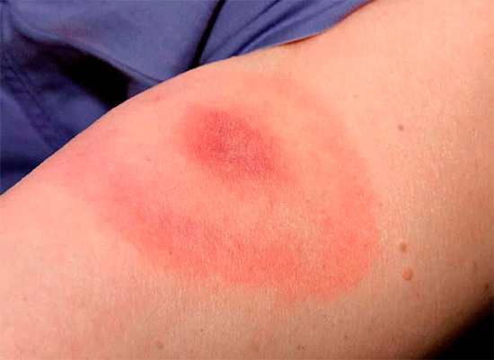 Sprechen wir darüber, wie sich eine allergische Reaktion des Körpers auf Insektenstiche äußern kann und welche Gefahr dies in manchen Fällen mit sich bringen kann.