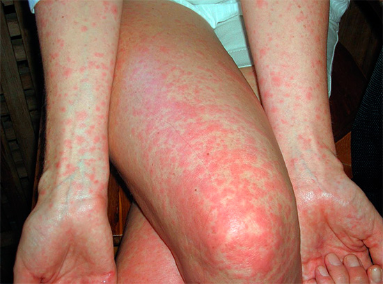 Eine Allergie auf einen Insektenstich kann sich auch als feiner Ausschlag am ganzen Körper oder an einzelnen Stellen äußern.