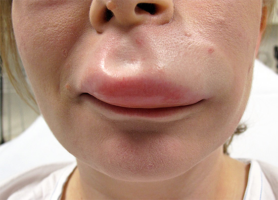 Selbst ein Wespenstich in die Lippe sieht ziemlich erschreckend aus. Stellen Sie sich vor, was passiert, wenn mehrere Insekten den Hals einer Person stechen... Selbst ein Wespenstich in die Lippe sieht ziemlich erschreckend aus. Stellen Sie sich vor, was passiert, wenn mehrere Insekten den Hals einer Person stechen...