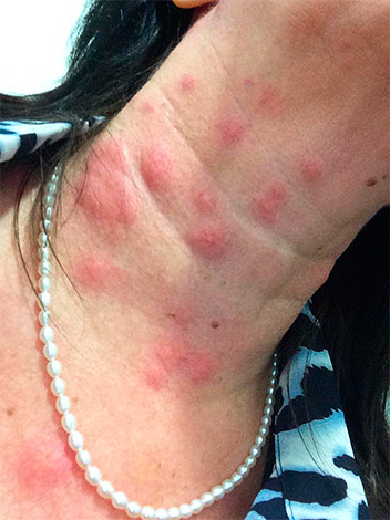 Das Foto zeigt massenhafte Wanzenstiche am Hals einer Frau. Das Foto zeigt massenhafte Wanzenstiche am Hals einer Frau.