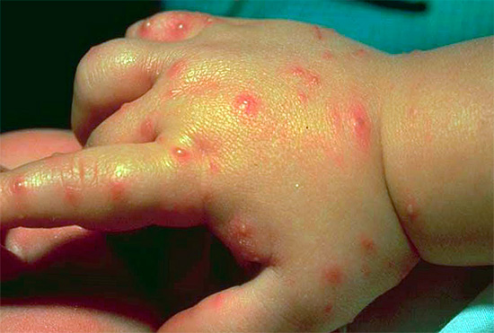 Kinderhand, von Bettwanzen gestochen Kinderhand, von Bettwanzen gestochen