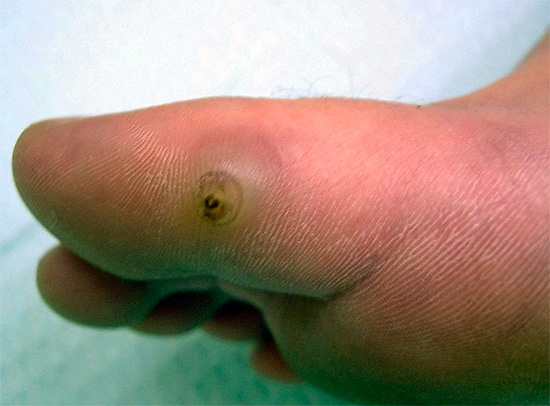 Sandflöhe können unter die Haut eindringen und zu ernsthaften und gefährlichen Entzündungen führen. Sandflöhe können unter die Haut eindringen und zu ernsthaften und gefährlichen Entzündungen führen.