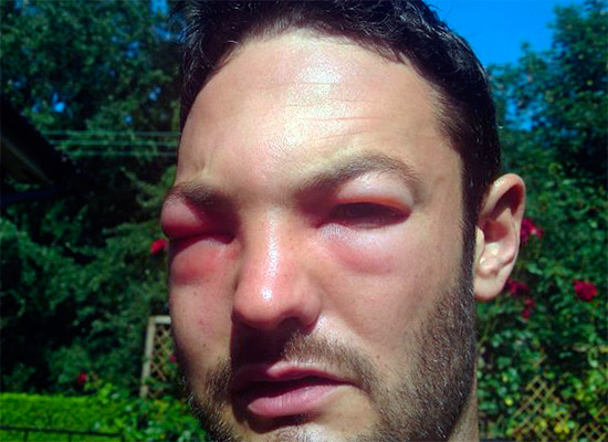 Wespenstiche im Gesicht können nicht nur zur Schließung beider Augen führen, sondern insgesamt eine erhöhte Lebensgefahr für den Menschen darstellen.